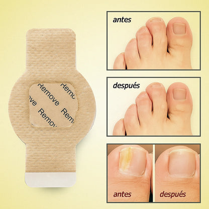 🦶 ¡OFERTA 2x1!  Tratamiento nocturno para el hongo de las uñas ¡Recupera su apariencia saludable!